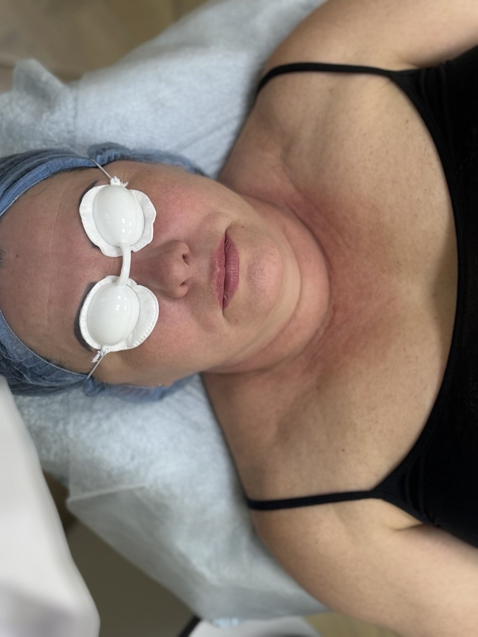 фотоомоложение лица и шеи и зоны декольте